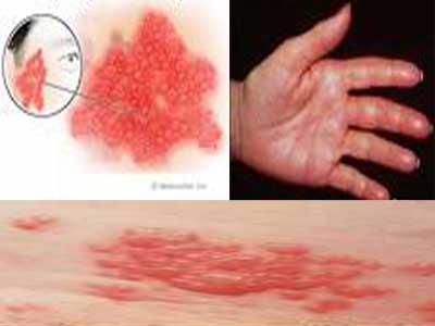 Medicine Acupuncture Herbal Treatment Cure Shingles Herbs Kuala Lumpur Medical Treatment Cure Centre