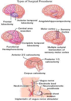 Medicine Acupuncture Herbal Treatment Cure Epilepsy Herbs Kuala Lumpur Medical Treatment Cure Centre