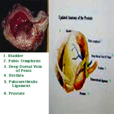 Medicine Acupuncture Herbal Treatment Cure Bladder Cancer Herbs Kuala Lumpur Medical Treatment Cure Centre